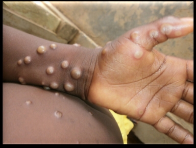 A person with monkeypox has been found in Bengaluru